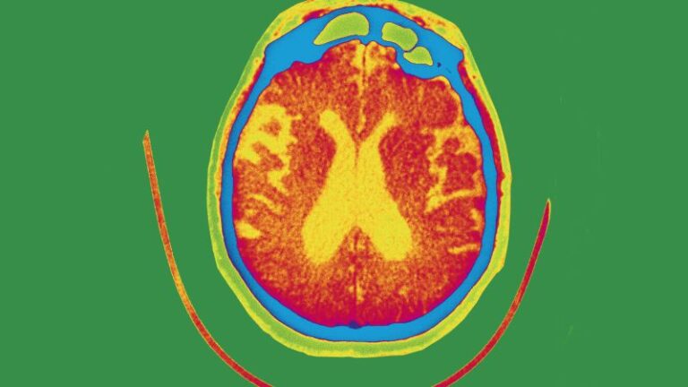 La terapia experimental con gantenerumab no logra retrasar ni mejorar la pérdida de memoria del Alzheimer en ensayos clínicos