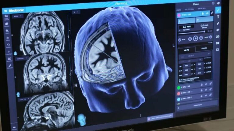 Anuncian avances en investigación de enfermedad de Alzheimer