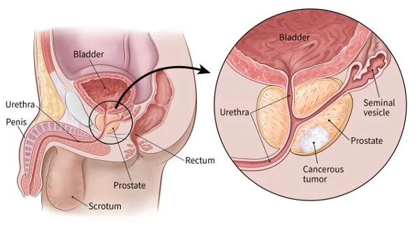 0:08 / 1:38  10 Warning Signs Of Prostate Cancer – DON’T BE STUBBORN!