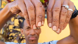 Dominicano con condición extrema: sus manos sudan como si fuera una llave abierta – Remolacha