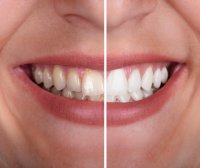 5 alimentos que blanquean los dientes, afirman odontólogos – Remolacha